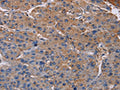 The image on the left is immunohistochemistry of paraffin-embedded Human liver cancer tissue using CSB-PA289822(NDUFA9 Antibody) at dilution 1/20, on the right is treated with fusion protein. (Original magnification: ×200)