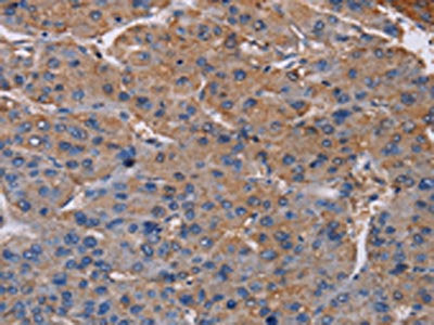 The image on the left is immunohistochemistry of paraffin-embedded Human liver cancer tissue using CSB-PA289822(NDUFA9 Antibody) at dilution 1/20, on the right is treated with fusion protein. (Original magnification: ×200)