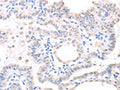 The image on the left is immunohistochemistry of paraffin-embedded Human thyroid cancer tissue using CSB-PA289847(APEX1 Antibody) at dilution 1/20, on the right is treated with fusion protein. (Original magnification: ×200)