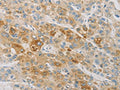 The image on the left is immunohistochemistry of paraffin-embedded Human liver cancer tissue using CSB-PA289963(ACSL4 Antibody) at dilution 1/25, on the right is treated with fusion protein. (Original magnification: ×200)