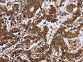 The image on the left is immunohistochemistry of paraffin-embedded Human liver cancer tissue using CSB-PA290047(FGF21 Antibody) at dilution 1/20, on the right is treated with fusion protein. (Original magnification: ×200)