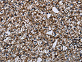 The image on the left is immunohistochemistry of paraffin-embedded Human prostate cancer tissue using CSB-PA290518(FAM89B Antibody) at dilution 1/30, on the right is treated with fusion protein. (Original magnification: ×200)
