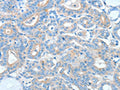The image on the left is immunohistochemistry of paraffin-embedded Human thyroid cancer tissue using CSB-PA290707(AGO2 Antibody) at dilution 1/20, on the right is treated with fusion protein. (Original magnification: ×200)