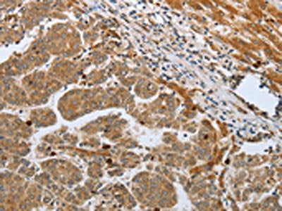The image on the left is immunohistochemistry of paraffin-embedded Human liver cancer tissue using CSB-PA291244(CASP12 Antibody) at dilution 1/50, on the right is treated with synthetic peptide. (Original magnification: ×200)