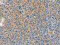 The image on the left is immunohistochemistry of paraffin-embedded Human liver cancer tissue using CSB-PA291937(BRCA1 Antibody) at dilution 1/35, on the right is treated with fusion protein. (Original magnification: ×200)