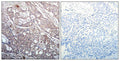 Immunohistochemical analysis of paraffin-embedded human breast carcinoma tissue using IkB-b(Phospho-Ser23) Antibody(left) or the same antibody preincubated with blocking peptide(right).
