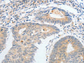 The image on the left is immunohistochemistry of paraffin-embedded Human colon cancer tissue using CSB-PA292099(CALCR Antibody) at dilution 1/25, on the right is treated with fusion protein. (Original magnification: ×200)