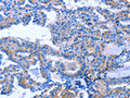 The image on the left is immunohistochemistry of paraffin-embedded Human thyroid cancer tissue using CSB-PA292270(ACVR2B Antibody) at dilution 1/25, on the right is treated with fusion protein. (Original magnification: ×200)