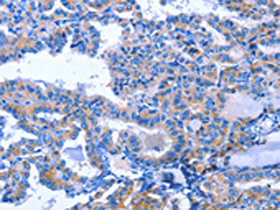 The image on the left is immunohistochemistry of paraffin-embedded Human thyroid cancer tissue using CSB-PA292270(ACVR2B Antibody) at dilution 1/25, on the right is treated with fusion protein. (Original magnification: ×200)