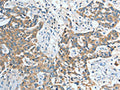 The image on the left is immunohistochemistry of paraffin-embedded Human esophagus cancer tissue using CSB-PA292651(IL12RB1 Antibody) at dilution 1/20, on the right is treated with fusion protein. (Original magnification: ×200)