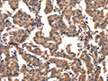 The image on the left is immunohistochemistry of paraffin-embedded Human breast cancer tissue using CSB-PA292680(CGA Antibody) at dilution 1/65, on the right is treated with fusion protein. (Original magnification: ×200)