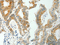 The image on the left is immunohistochemistry of paraffin-embedded Human colon cancer tissue using CSB-PA292716(SELM Antibody) at dilution 1/50, on the right is treated with fusion protein. (Original magnification: ×200)