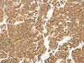 The image on the left is immunohistochemistry of paraffin-embedded Human breast cancer tissue using CSB-PA292717(LYZ Antibody) at dilution 1/20, on the right is treated with fusion protein. (Original magnification: ×200)