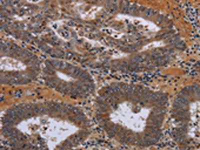 The image on the left is immunohistochemistry of paraffin-embedded Human colon cancer tissue using CSB-PA292777(JMJD7 Antibody) at dilution 1/30, on the right is treated with fusion protein. (Original magnification: ×200)