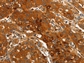 The image on the left is immunohistochemistry of paraffin-embedded Human lung cancer tissue using CSB-PA292969(ORM2 Antibody) at dilution 1/40, on the right is treated with fusion protein. (Original magnification: ×200)