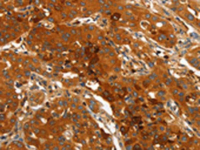 The image on the left is immunohistochemistry of paraffin-embedded Human lung cancer tissue using CSB-PA292969(ORM2 Antibody) at dilution 1/40, on the right is treated with fusion protein. (Original magnification: ×200)
