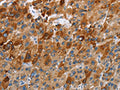 The image on the left is immunohistochemistry of paraffin-embedded Human liver cancer tissue using CSB-PA293047(CCR9 Antibody) at dilution 1/40, on the right is treated with fusion protein. (Original magnification: ×200)