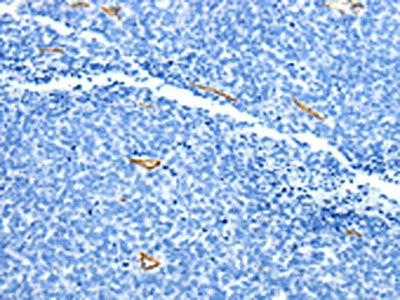 The image on the left is immunohistochemistry of paraffin-embedded Human ovarian cancer tissue using CSB-PA293186(ADIPOQ Antibody) at dilution 1/15, on the right is treated with fusion protein. (Original magnification: ×200)