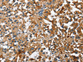The image on the left is immunohistochemistry of paraffin-embedded Human thyroid cancer tissue using CSB-PA293976(STK17B Antibody) at dilution 1/25, on the right is treated with fusion protein. (Original magnification: ×200)