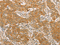 The image on the left is immunohistochemistry of paraffin-embedded Human gastic cancer tissue using CSB-PA294068(SNAP91 Antibody) at dilution 1/20, on the right is treated with fusion protein. (Original magnification: ×200)