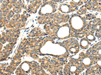 The image on the left is immunohistochemistry of paraffin-embedded Human thyroid cancer tissue using CSB-PA294107(MMP9 Antibody) at dilution 1/20, on the right is treated with synthetic peptide. (Original magnification: ×200)