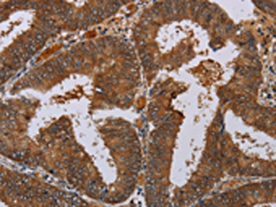 The image on the left is immunohistochemistry of paraffin-embedded Human colon cancer tissue using CSB-PA294114(LCMT1 Antibody) at dilution 1/20, on the right is treated with fusion protein. (Original magnification: ×200)