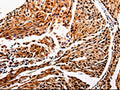 The image is immunohistochemistry of paraffin-embedded Human cervical cancer tissue using CSB-PA294228(IL10RB Antibody) at dilution 1/20. (Original magnification: ×200)
