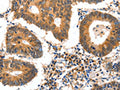 The image on the left is immunohistochemistry of paraffin-embedded Human colon cancer tissue using CSB-PA294342(GDF6 Antibody) at dilution 1/25, on the right is treated with synthetic peptide. (Original magnification: ×200)