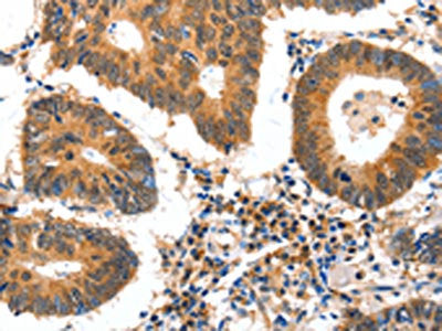 The image on the left is immunohistochemistry of paraffin-embedded Human colon cancer tissue using CSB-PA294342(GDF6 Antibody) at dilution 1/25, on the right is treated with synthetic peptide. (Original magnification: ×200)