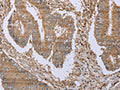 The image on the left is immunohistochemistry of paraffin-embedded Human colon cancer tissue using CSB-PA295162(FHL1 Antibody) at dilution 1/20, on the right is treated with fusion protein. (Original magnification: ×200)