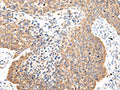 The image on the left is immunohistochemistry of paraffin-embedded Human lung cancer tissue using CSB-PA295305(COL8A2 Antibody) at dilution 1/20, on the right is treated with synthetic peptide. (Original magnification: ×200)