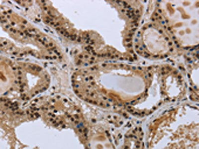 The image on the left is immunohistochemistry of paraffin-embedded Human colon cancer tissue using CSB-PA295309(GCKR Antibody) at dilution 1/50, on the right is treated with fusion protein. (Original magnification: ×200)