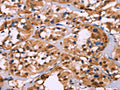 The image on the left is immunohistochemistry of paraffin-embedded Human thyroid cancer tissue using CSB-PA296044(HIST1H1C Antibody) at dilution 1/70, on the right is treated with fusion protein. (Original magnification: ×200)