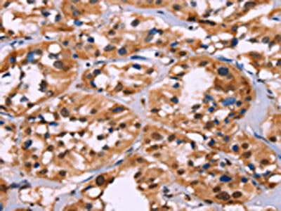 The image on the left is immunohistochemistry of paraffin-embedded Human thyroid cancer tissue using CSB-PA296044(HIST1H1C Antibody) at dilution 1/70, on the right is treated with fusion protein. (Original magnification: ×200)