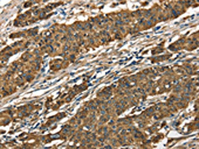 The image on the left is immunohistochemistry of paraffin-embedded Human gastic cancer tissue using CSB-PA296813(CTSE Antibody) at dilution 1/40, on the right is treated with fusion protein. (Original magnification: ×200)