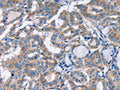 The image on the left is immunohistochemistry of paraffin-embedded Human thyroid cancer tissue using CSB-PA296843(KCNQ5 Antibody) at dilution 1/30, on the right is treated with fusion protein. (Original magnification: ×200)