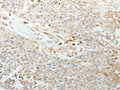 The image on the left is immunohistochemistry of paraffin-embedded Human esophagus cancer tissue using CSB-PA296975(TNC Antibody) at dilution 1/30, on the right is treated with synthetic peptide. (Original magnification: ×200)