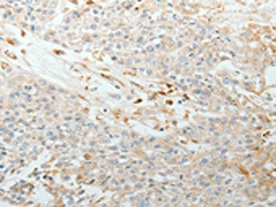 The image on the left is immunohistochemistry of paraffin-embedded Human esophagus cancer tissue using CSB-PA296975(TNC Antibody) at dilution 1/30, on the right is treated with synthetic peptide. (Original magnification: ×200)