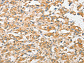 The image on the left is immunohistochemistry of paraffin-embedded Human thyroid cancer tissue using CSB-PA296982(TLR5 Antibody) at dilution 1/30, on the right is treated with fusion protein. (Original magnification: ×200)