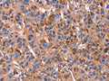 The image on the left is immunohistochemistry of paraffin-embedded Human liver cancer tissue using CSB-PA297000(PVR Antibody) at dilution 1/20, on the right is treated with fusion protein. (Original magnification: ×200)
