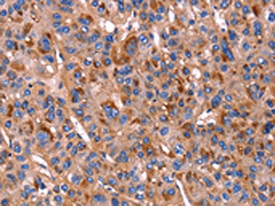 The image on the left is immunohistochemistry of paraffin-embedded Human liver cancer tissue using CSB-PA297000(PVR Antibody) at dilution 1/20, on the right is treated with fusion protein. (Original magnification: ×200)