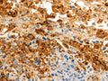 The image on the left is immunohistochemistry of paraffin-embedded Human ovarian cancer tissue using CSB-PA297038(SPP1 Antibody) at dilution 1/20, on the right is treated with fusion protein. (Original magnification: ×200)