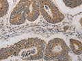 The image on the left is immunohistochemistry of paraffin-embedded Human colon cancer tissue using CSB-PA297162(CDKN1A Antibody) at dilution 1/20, on the right is treated with fusion protein. (Original magnification: ×200)