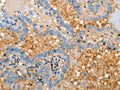 The image on the left is immunohistochemistry of paraffin-embedded Human thyroid cancer tissue using CSB-PA297198(APOH Antibody) at dilution 1/30, on the right is treated with fusion protein. (Original magnification: ×200)