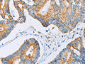 The image on the left is immunohistochemistry of paraffin-embedded Human colon cancer tissue using CSB-PA297340(ACAA2 Antibody) at dilution 1/30, on the right is treated with fusion protein. (Original magnification: ×200)