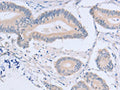 The image on the left is immunohistochemistry of paraffin-embedded Human colon cancer tissue using CSB-PA297536(ACMSD Antibody) at dilution 1/15, on the right is treated with fusion protein. (Original magnification: ×200)