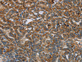 The image on the left is immunohistochemistry of paraffin-embedded Human thyroid cancer tissue using CSB-PA297822(HSD17B14 Antibody) at dilution 1/40, on the right is treated with fusion protein. (Original magnification: ×200)