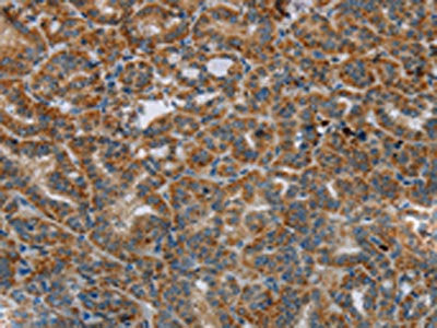 The image on the left is immunohistochemistry of paraffin-embedded Human thyroid cancer tissue using CSB-PA297822(HSD17B14 Antibody) at dilution 1/40, on the right is treated with fusion protein. (Original magnification: ×200)