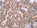 The image on the left is immunohistochemistry of paraffin-embedded Human thyroid cancer tissue using CSB-PA297913(STXBP2 Antibody) at dilution 1/20, on the right is treated with fusion protein. (Original magnification: ×200)