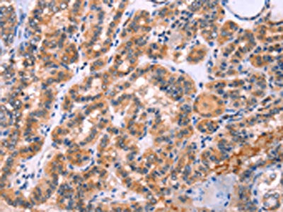 The image on the left is immunohistochemistry of paraffin-embedded Human thyroid cancer tissue using CSB-PA297913(STXBP2 Antibody) at dilution 1/20, on the right is treated with fusion protein. (Original magnification: ×200)